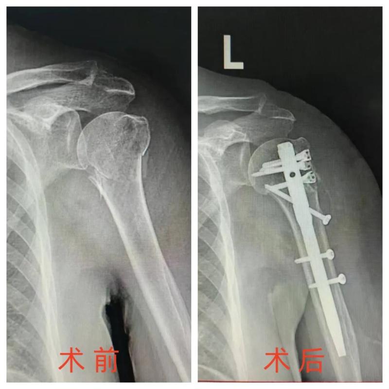 【中心医院·医者红】multilock髓内钉:肱骨近段骨折治疗的微创利器 【中心医院·医者红】multilock髓内钉:肱骨近段骨折治疗的微创利器