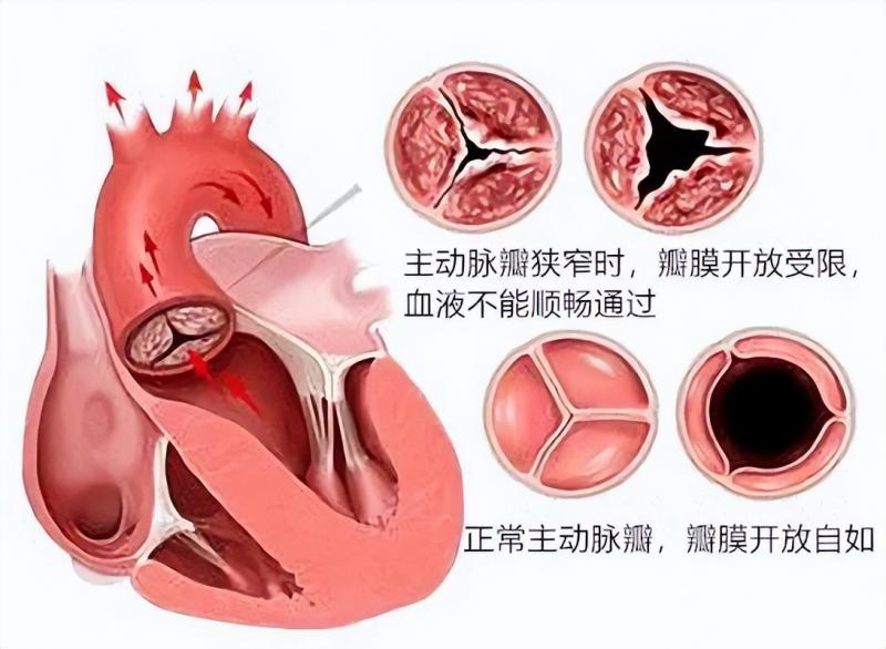 【中心医院·医者红】全国首批!湘潭市中心医院完成renatus®经导管主动脉瓣系统植入 【中心医院·医者红】全国首批!湘潭市中心医院完成renatus®经导管主动脉瓣系统植入