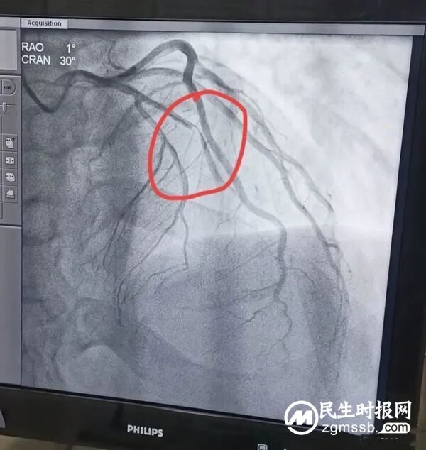 曲周县医院心内科在60分钟内顺利完成急性心梗冠脉支架植入术