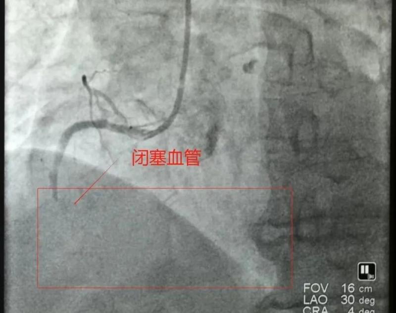 【卓越医疗】仅14分钟,我院胸痛中心团队与时间赛跑,再刷心梗抢救速度 【卓越医疗】仅14分钟,我院胸痛中心团队与时间赛跑,再刷心梗抢救速度