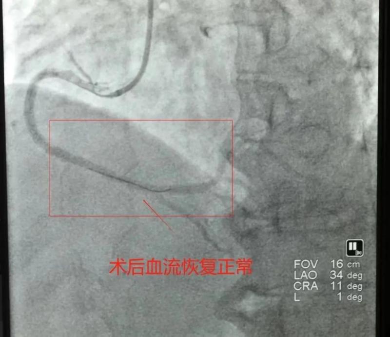 【卓越医疗】仅14分钟,我院胸痛中心团队与时间赛跑,再刷心梗抢救速度 【卓越医疗】仅14分钟,我院胸痛中心团队与时间赛跑,再刷心梗抢救速度