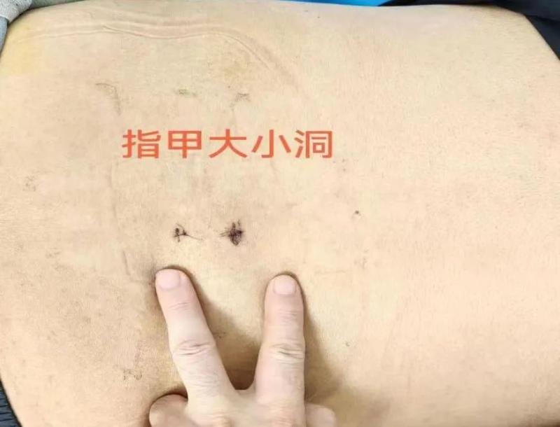 走不动、走不远?ube微创技术,为腰椎管狭窄患者重塑行走之路 走不动、走不远?ube微创技术,为腰椎管狭窄患者重塑行走之路