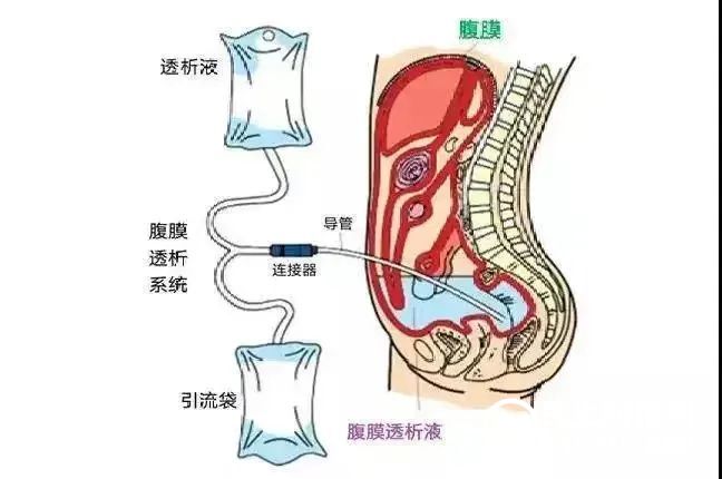 35岁小伙身患尿毒症，腹膜透析助力其正常生活