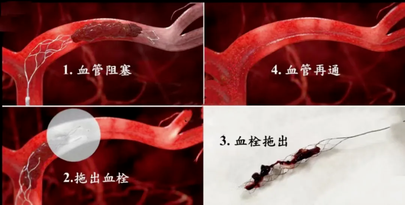 湘潭县人民医院:卒中中心团队打赢“卒中取栓”保卫战 湘潭县人民医院:卒中中心团队打赢“卒中取栓”保卫战