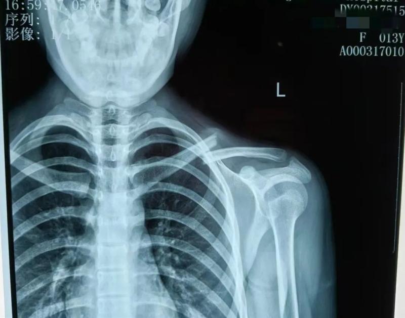 【卓越医疗】锁骨骨折不开刀 中医正骨有妙招 【卓越医疗】锁骨骨折不开刀 中医正骨有妙招
