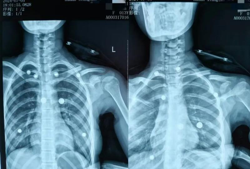 【卓越医疗】锁骨骨折不开刀 中医正骨有妙招 【卓越医疗】锁骨骨折不开刀 中医正骨有妙招