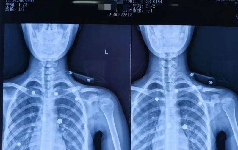 【卓越医疗】锁骨骨折不开刀 中医正骨有妙招 【卓越医疗】锁骨骨折不开刀 中医正骨有妙招
