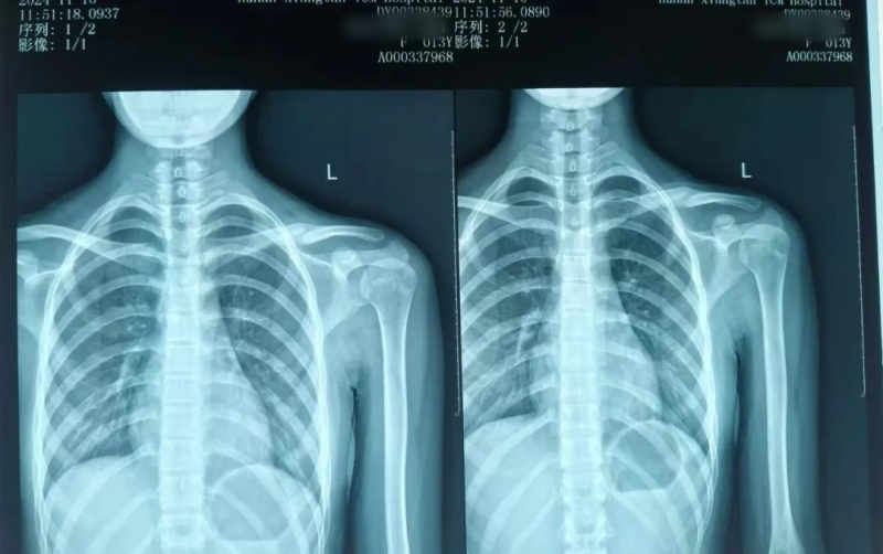 【卓越医疗】锁骨骨折不开刀 中医正骨有妙招 【卓越医疗】锁骨骨折不开刀 中医正骨有妙招