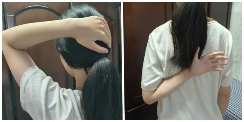 【卓越医疗】锁骨骨折不开刀 中医正骨有妙招 【卓越医疗】锁骨骨折不开刀 中医正骨有妙招