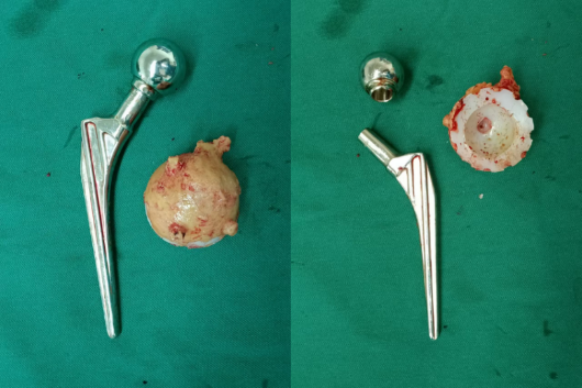 【中心医院·医者红】髋关节置换20年后两条腿长度相差5cm! 3d技术助力翻修“长短腿”! 【中心医院·医者红】髋关节置换20年后两条腿长度相差5cm! 3d技术助力翻修“长短腿”!