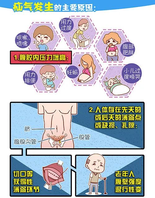 【日间手术】日行一“疝” 【日间手术】日行一“疝”
